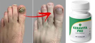 Put This Strong Spice In Your Shoes To Destroy Nail Fungus