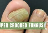 One Tablespoon of THIS Wipes Out Nail and Skin Fungus Fast