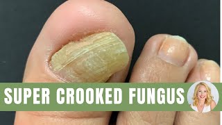 Nail-and-Skin-Fungus
