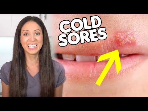 Herpesyl – Best Supplement for Cold Sores