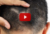 Secret hair growth potion restores scalp health in 3 Weeks