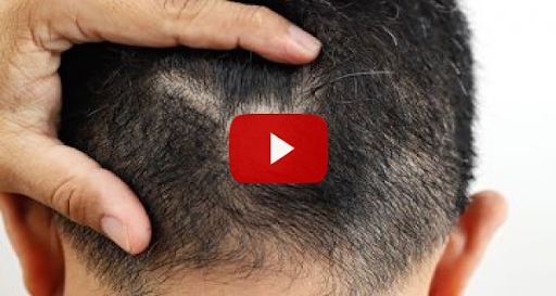 Secret hair growth potion restores scalp health in 3 Weeks