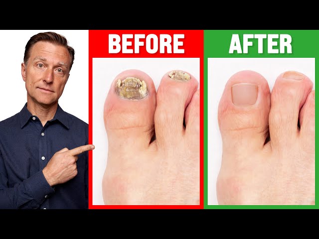 5-minute Craft: THIS Eliminate Nail Infection