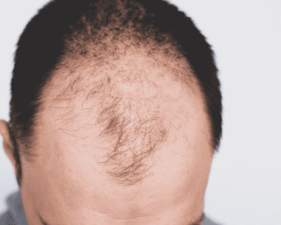 Homeopathy-Treatment-of-Male-Pattern-Baldness-1